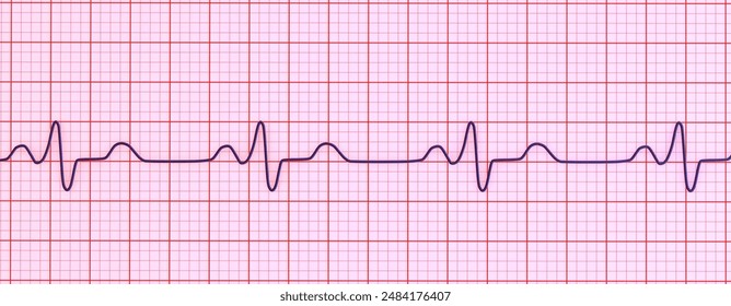 3D illustration visualizing an ECG with Bundle branch block, showing widened QRS complexes, altered ventricular depolarization.