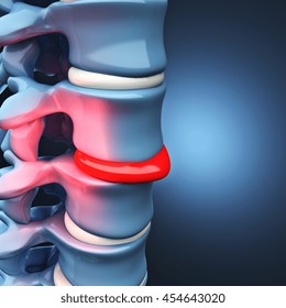 3d Image Of Herniated Disk Human Spinal