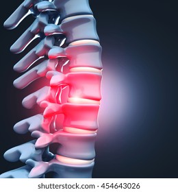 3d Image Of Herniated Disk Human Spinal