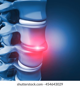 3d Image Of Herniated Disk Human Spinal