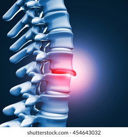 3d Image Of Herniated Disk Human Spinal