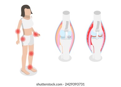 3D Isometric Flat  Conceptual Illustration of Rheumatism, Osteoarthritis and Rheumatoid Arthritis - Powered by Shutterstock