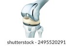 3D knee implant and prosthesis design for a human knee that has lost its function. Computer-designed human knee joint prosthesis.

