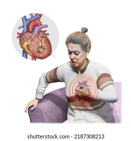 3d Medical Illustration To Explain Angina Pectoris 