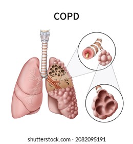 
3d Medical Illustration To Explain COPD