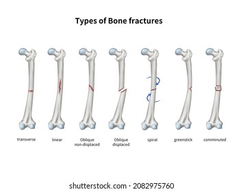2,398 Types of fracture Images, Stock Photos & Vectors | Shutterstock