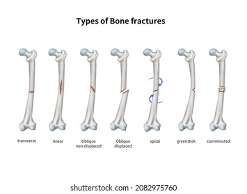 3d Medical Illustration Explain Type Fracture Stock Illustration ...