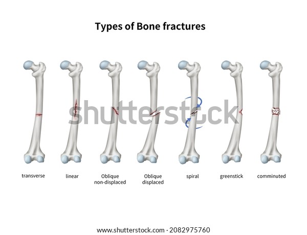 3d Medical Illustration Explain Type Fracture Stock Illustration 