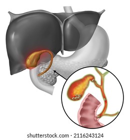 3d Medical Illustration Explaining Acute Cholecystitis