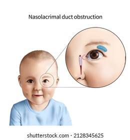 3d Medical Illustration Explaining Nasolacrimal Duct Obstruction