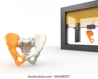 3d printed hip bone