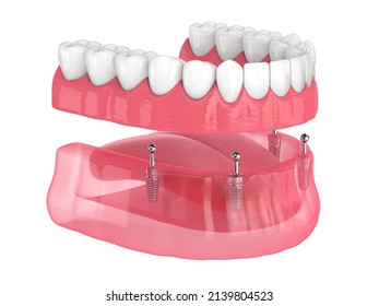  3d render of all-on-4 removable, implants supported, overdenture installation over white background