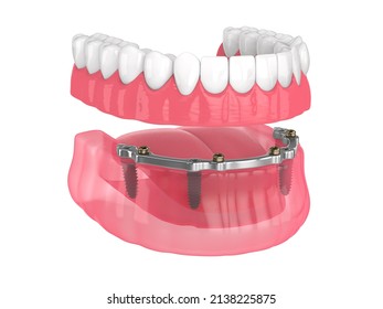 3d render of bar retained removable overdenture installation supported by implants over white backgroud