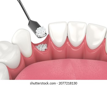 3D render of dental bone grafting with dental bone biomaterial over white background. Jaw bone augmentation procedure concept.