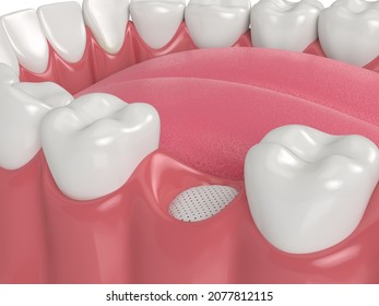 3D Render Of Dental Bone Grafting With Membrane