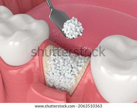 3D render of dental bone grafting with bone biomaterial application over white background. Jaw bone augmentation concept. Foto stock © 