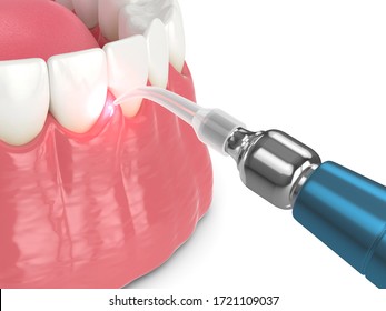 3d Render Of Dental Diode Laser Used To Treat Gums. The Concept Of Using Laser Therapy In The Treatment Of Gums