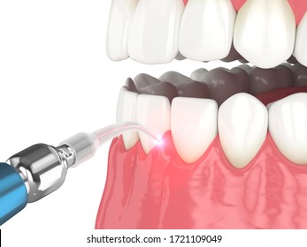 3d Render Of Dental Diode Laser Used To Treat Gums. The Concept Of Using Laser Therapy In The Treatment Of Gums