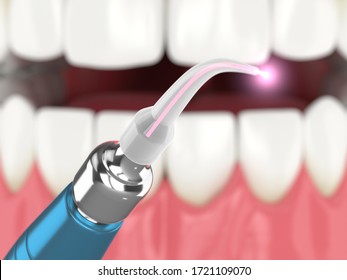 3D-Rendering von Dentaldiode Laser zur Behandlung von Zahnfleisch. Das Konzept der Anwendung der Lasertherapie bei der Behandlung von Zahngummen