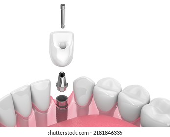 3d Render Of Dental Implant In Jaw Over White Background