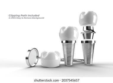 3d render Dental Implants surgery concept Pen Tool Created Clipping Path Included in JPEG Easy to Composite. - Powered by Shutterstock