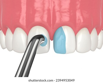 3d render of diastema closure using bonding procedure. Part 3. Removing the mild acid. Closing diastema procedure concept.