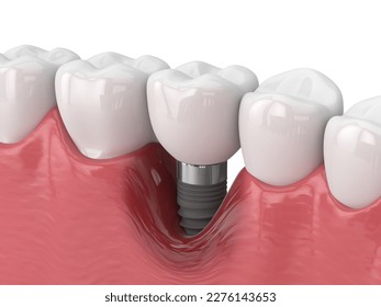 3d render of human jaw with peri implantitis disease over white background