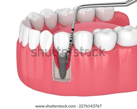 3d render of human jaw with peri implantitis disease and periodontal sonda over white background