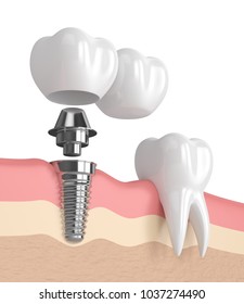 3d Render Implant Dental Cantilever Bridge Stock Illustration 1038214078