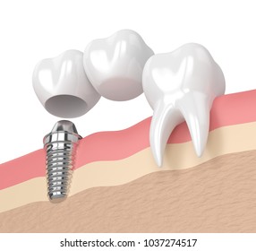 3d Render Implant Dental Cantilever Bridge Stock Illustration 