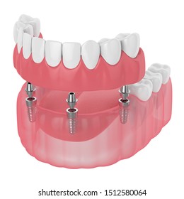 3d render of implant partial denture isolated over white background