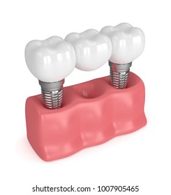 3d Render Of Implants In Gums With Dental Bridge Isolated Over White Background