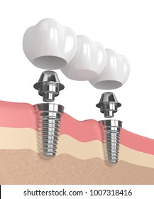 2,334 Implant abutments Images, Stock Photos & Vectors | Shutterstock