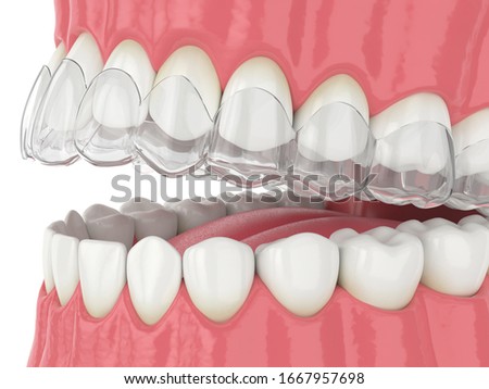 3d render of invisalign removable and invisible retainer on jaw over white background
