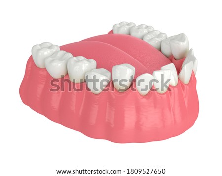 3d render of  jaw with abnormal teeth position. Orthodontic treatment concept. 