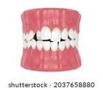 3d render of jaw with abnormal toothing isolated over white background