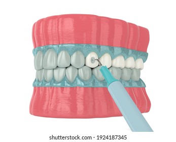 3d render of jaw with applying activating gel for teeth bleaching. Teeth whitening concept. 