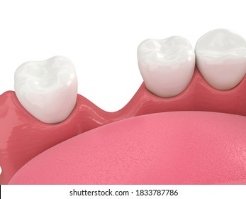 3d Render Of Jaw Bone Recession After Loosing Tooth Over White