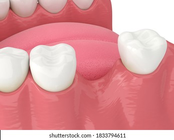 3d Render Of Jaw Bone Recession After Loosing Tooth Over White