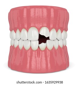 3d Render Jaw Broken Incisors Teeth Stock Illustration 1635929938 ...