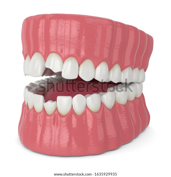 3d Render Jaw Broken Incisors Teeth Stock Illustration 1635929935 ...