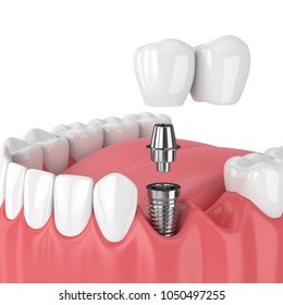 3d Render Of Jaw With Dental Cantilever Bridge  Isolated Over White Background