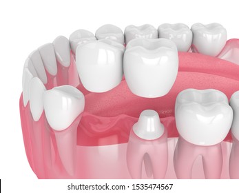 3d Render Of Jaw With Dental Cantilever Bridge Over White Background