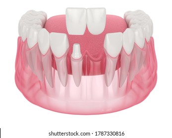 3d Render Of  Jaw With Dental Cantilever Bridge Over White Background