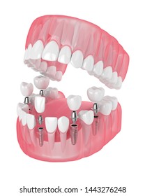3d render of jaw with dental implants isolated over white background