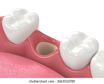 3D Render Of Jaw With Empty Socket Ready To Bone Grafting. Jaw Bone Augmentation Concept.