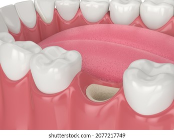 3D Render Of Jaw With Empty Socket Ready To Bone Grafting