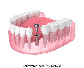 3d render of jaw with implant screw and healing cap over white background. Dental implantation concept