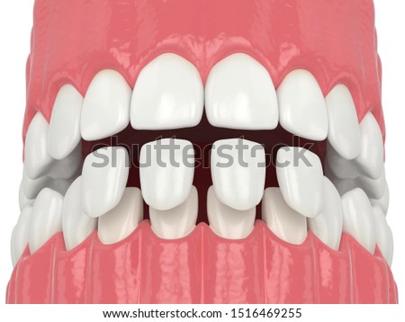 3d render of jaw with lower veneers over white