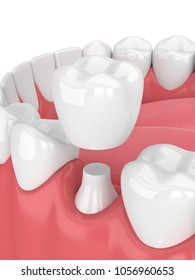 3d Render Of Jaw With Teeth And Dental Crown Restoration Over White Background